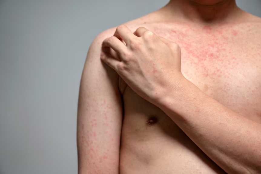 Measles outbreak in Texas raises concerns