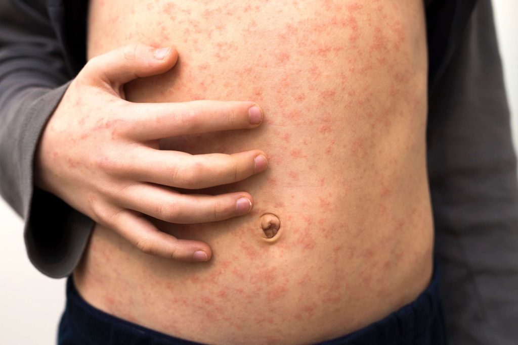 Unvaccinated New Mexico resident tests positive for measles after dying